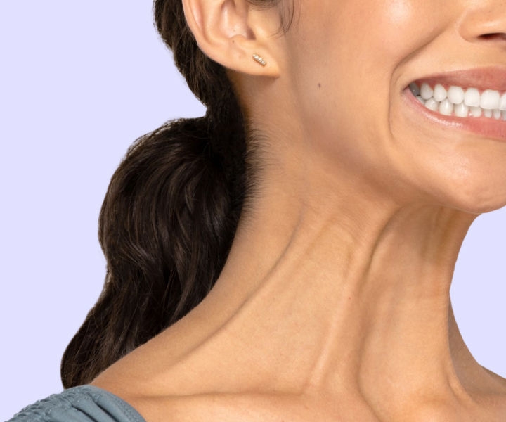 Botox Neck and Jaw example