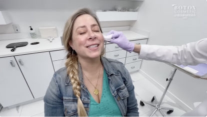 Botox Patient Stories - Marie